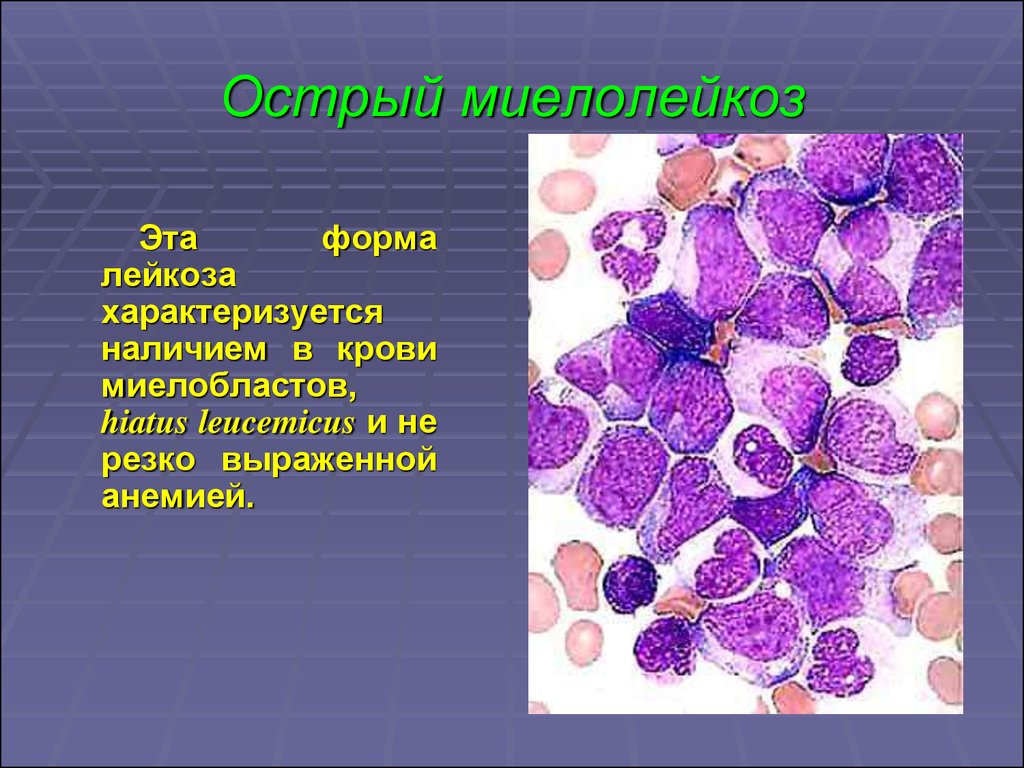 Острый миелоидный лейкоз прогноз. Острый миелобластный лейкоз. Острый миелобластный лейкоз (ОМЛ). Острый миелобластный лейкоз картина крови. Острый моноблпстеый лейкоз.