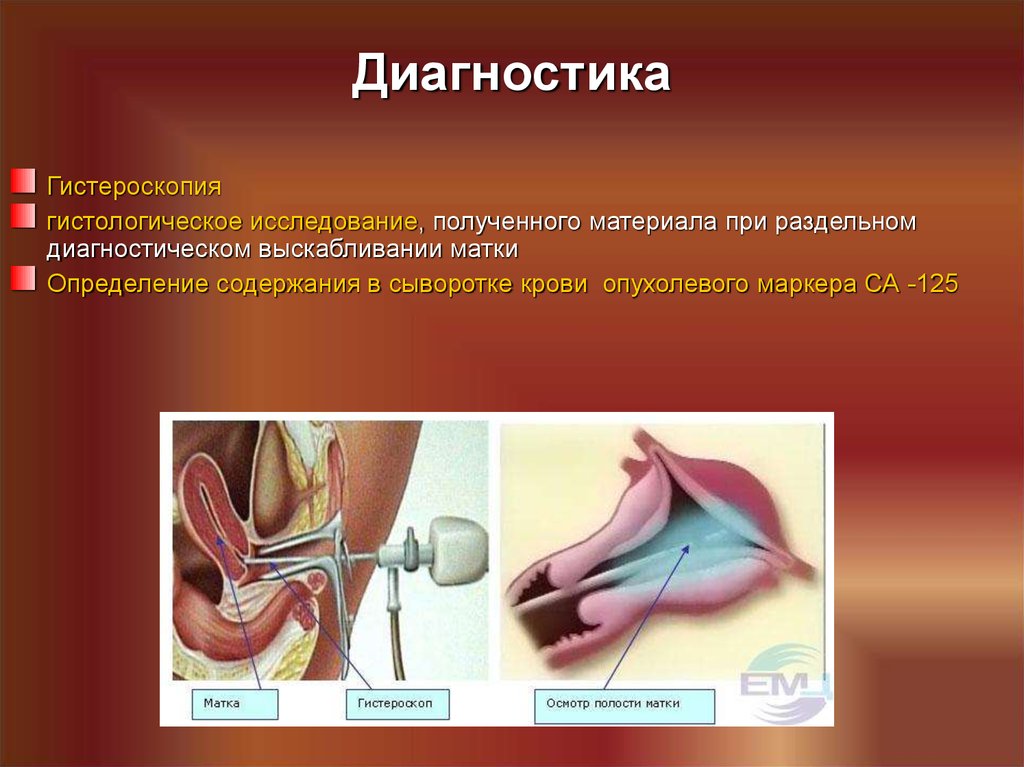 Гистероскопия раздельное выскабливание