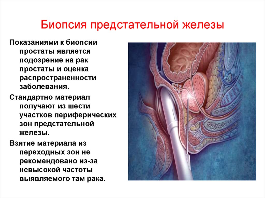 Как берут биопсию у мужчин. Зоны пункции предстательной железы. Биопсия предстательной железы. Пункционная биопсия предстательной железы. Простата анатомия.