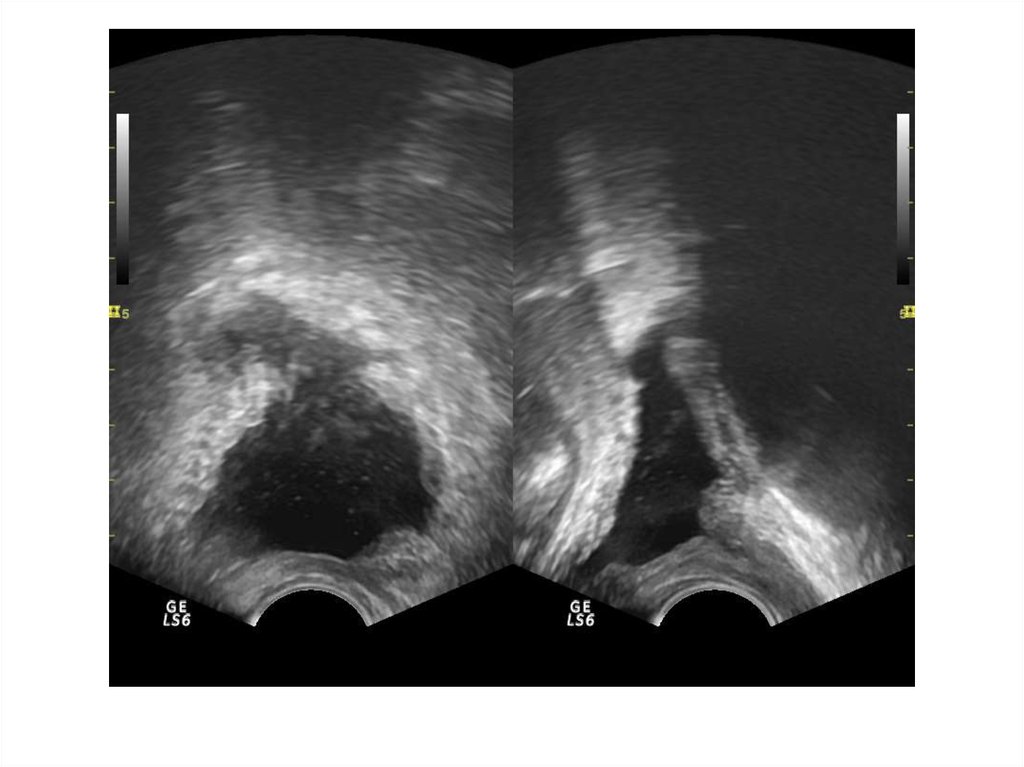 Фиброзные изменения предстательной железы. Семенные пузырьки на трузи. Хронический простатит на УЗИ. Зональная анатомия предстательной железы УЗИ.
