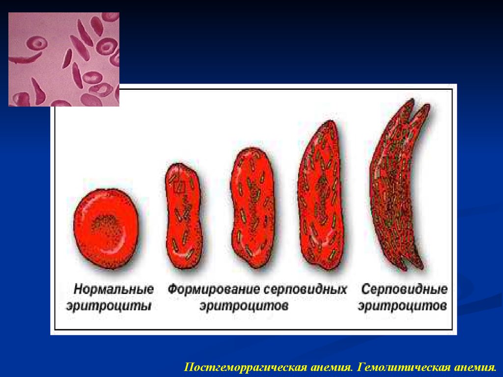 Постгеморрагическая анемия острая и хроническая картина крови