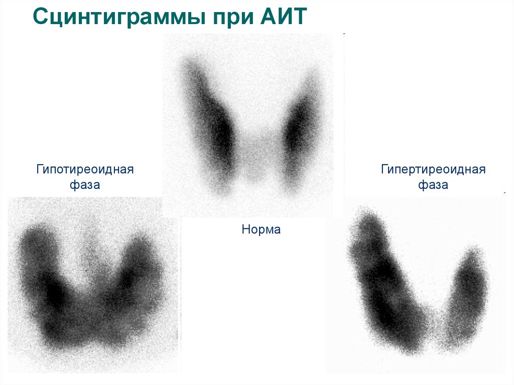 Аутоиммунные изменения щитовидной
