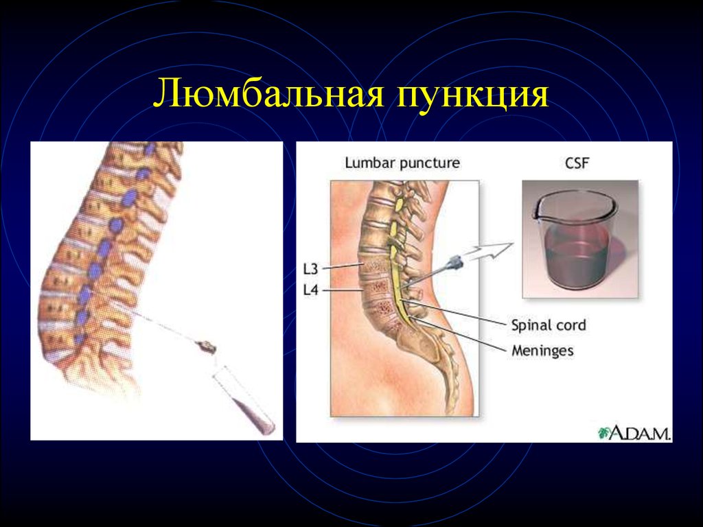 Люмбальная пункция презентация