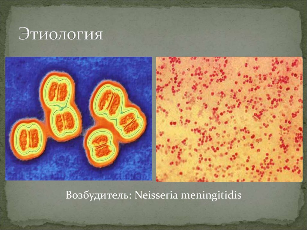 Менингококки микробиология. Менингококковая инфекция возбудитель этиология. Возбудитель (Neisseria meningitidis). Менингококки микробиология форма. Возбудитель - менингококк Neisseria meningitidis.