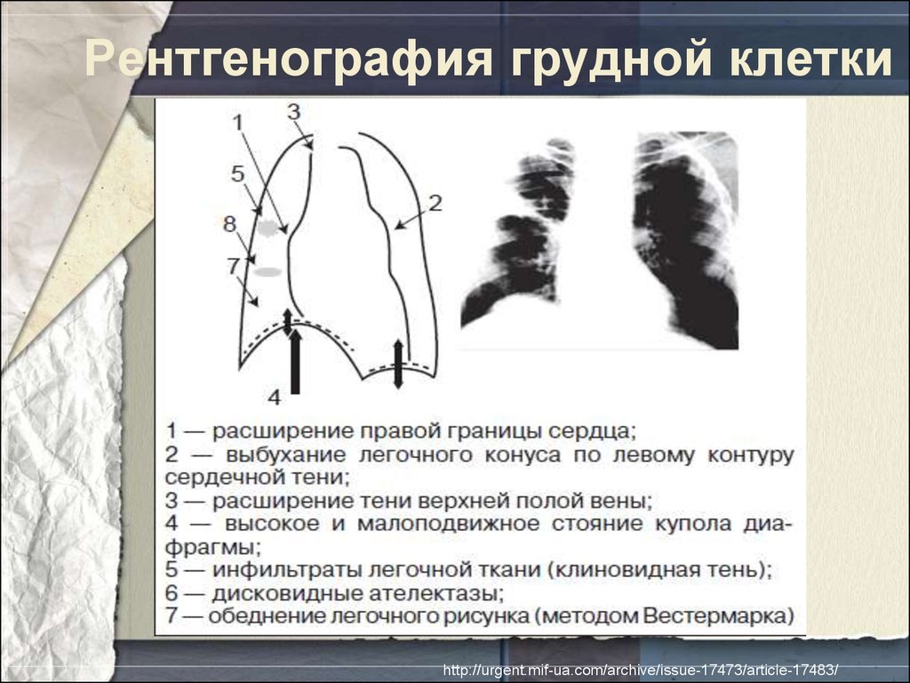 Расширение левой. Тромбоэмболия легочной артерии рентген. Расширение тени верхней полой вены на рентгенограмме. Рентгенография грудной клетки Тэла.