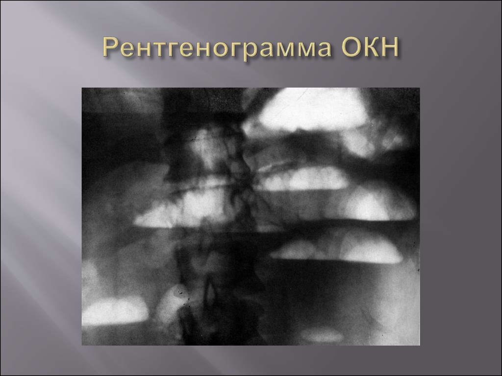 Острая кишечная непроходимость. Окн тонкокишечная непроходимость. Острая кишечная непроходимость (окн). Status localis острая кишечная непроходимость. Инфекционная кишечная непроходимость.