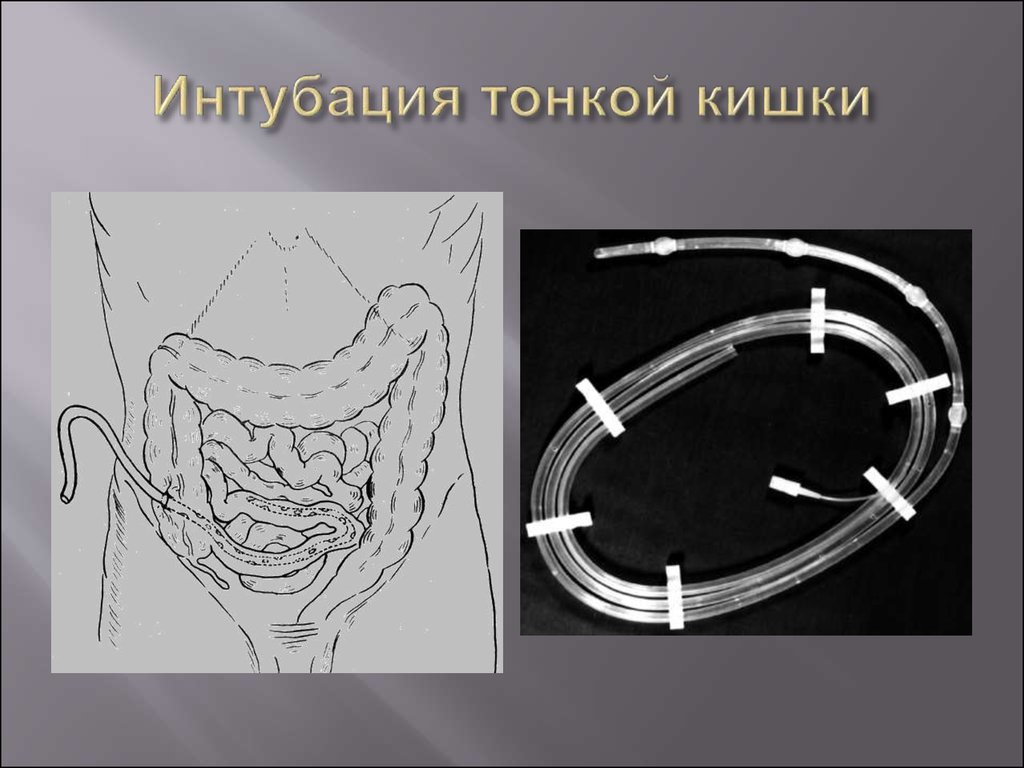 Острая кишечная непроходимость госпитальная хирургия презентация