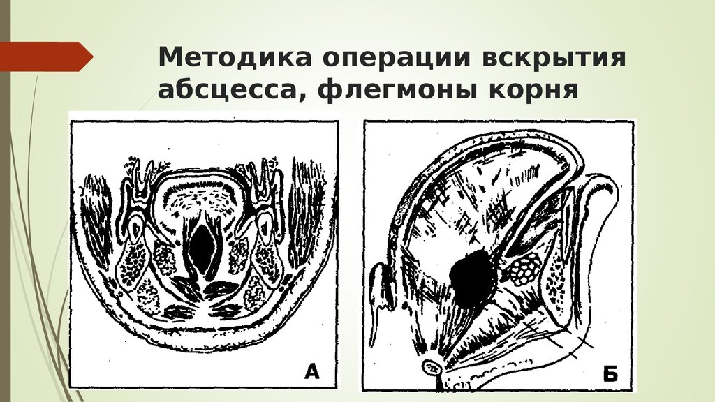 Абсцесс челюстно язычного желобка фото