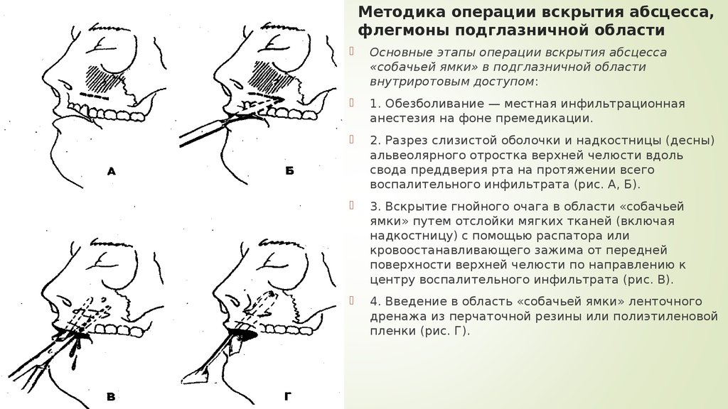 Методика операций. Вскрытие абсцесса подглазничной области. Хирургическое лечение флегмоны подглазничной области. Операция вскрытия абсцесса и флегмоны подглазничной области.. Вскрытие флегмоны этапы.