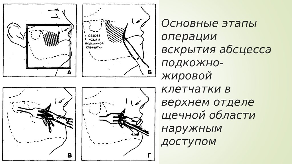 Вскрытие флегмон и абсцессов. Околочелюстная флегмона.