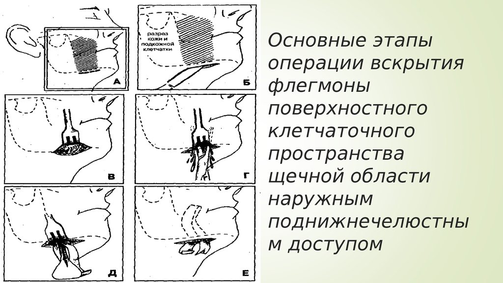 Вскрытие подапоневротической флегмоны