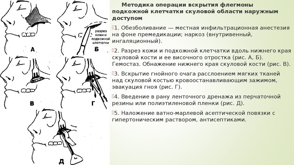 Флегмона челюсти фото