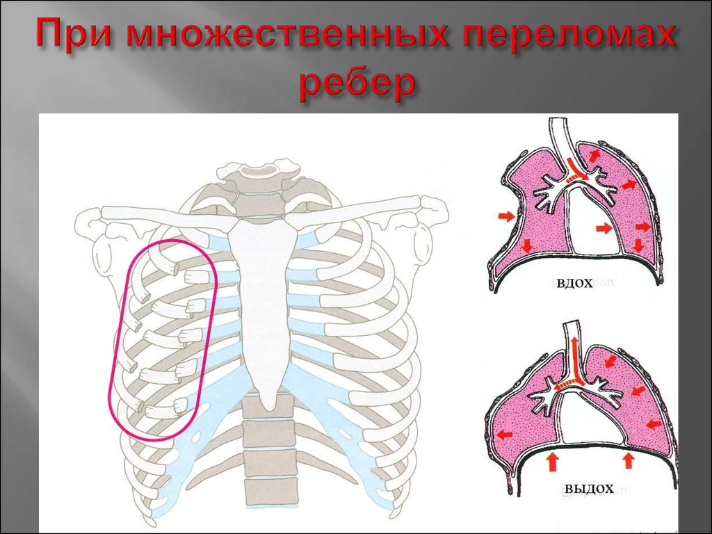 Презентация повреждения грудной клетки