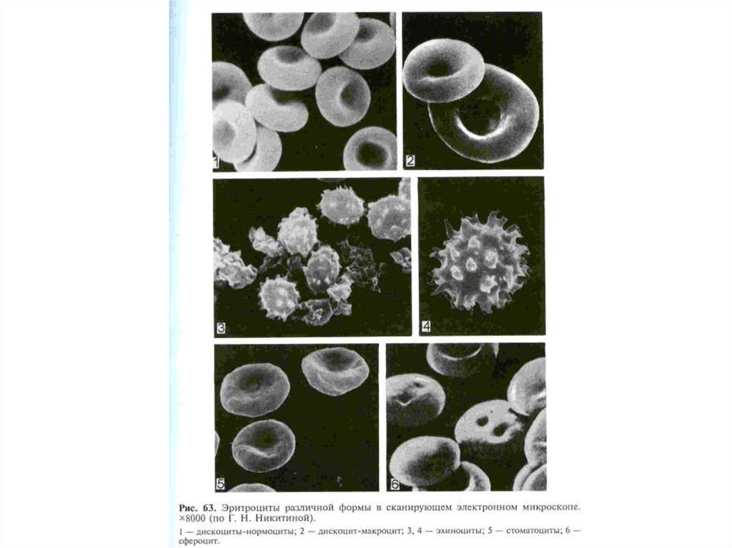 Макроциты. Эхиноциты эритроциты. Эритроциты различной формы в сканирующем электронном микроскопе. Эритроциты разной формы. Эритроциты электронный микроскоп.