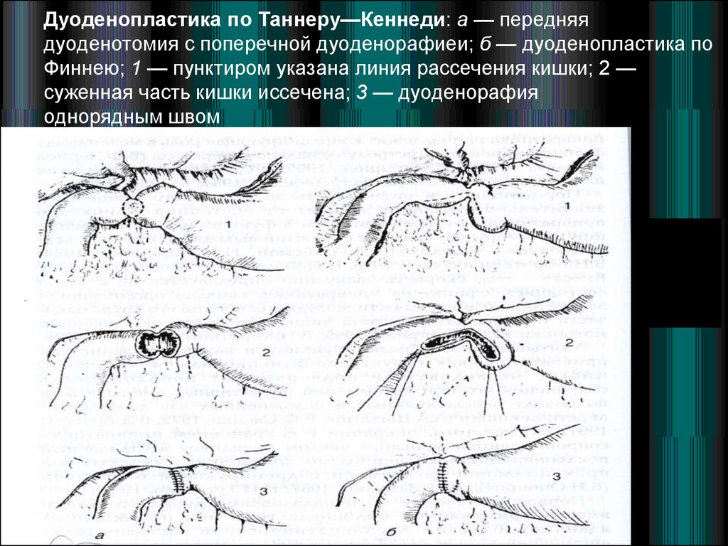 Пилоропластика по финнею схема