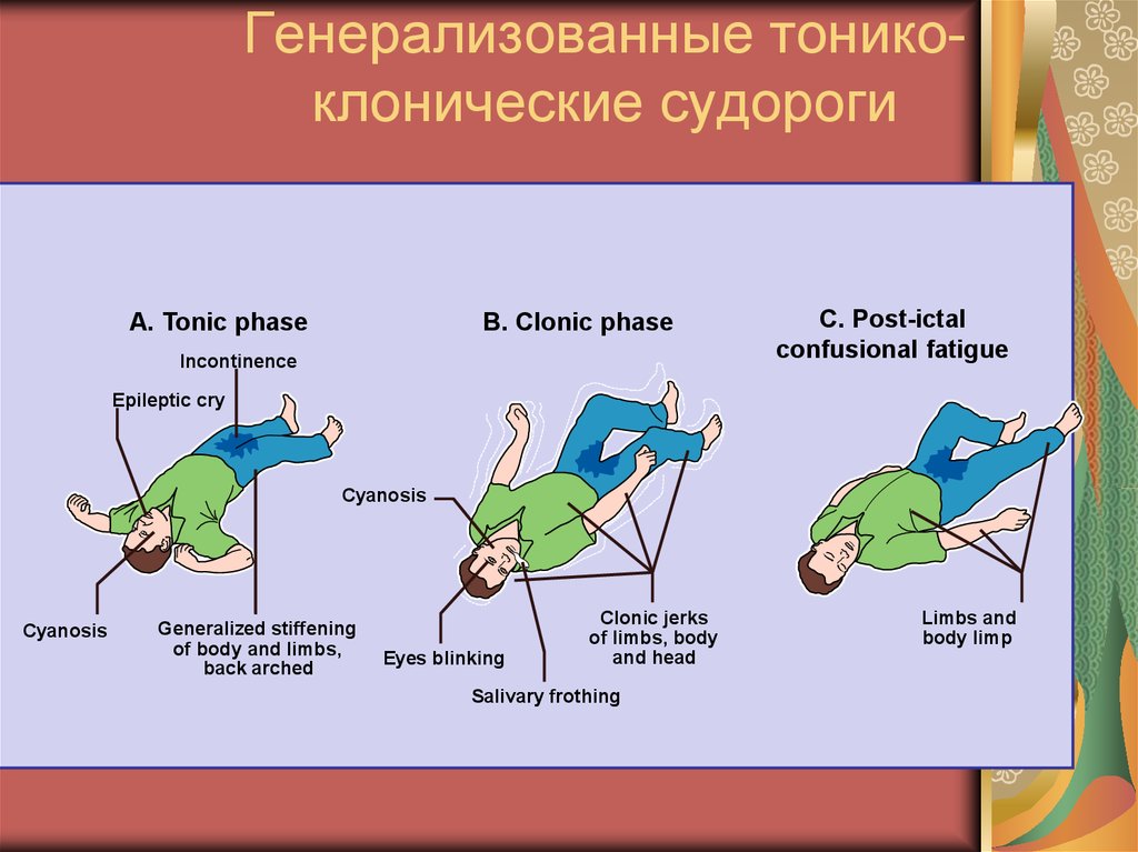 Клонические припадки. Тонико-клонические и клонико-тонические судороги. Генерализованные клонические судороги. Генерализованные тонико-клонические судороги - признак. Эпилепсия клонические судороги.