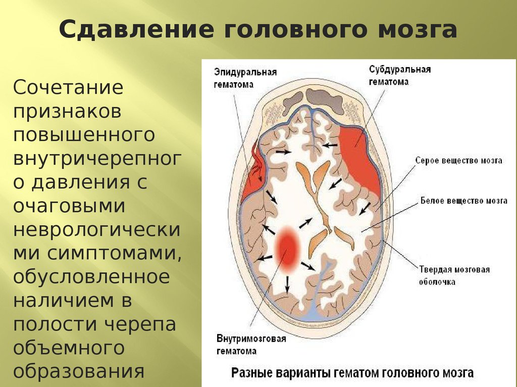 Сдавление мозга признаки. Субдуральная и эпидуральная гематома. Сдавление головного мозга. Сдавления вещества мозга. Сдавление головного мозга внутричерепными гематомами.