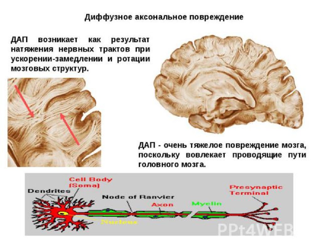 Диффузный характер головного мозга. Аксональные повреждения головного мозга. Диффузное аксональное поражение головного мозга. Дифузноаксенальное повреждение. Диффузное аксональное повреждение головного.