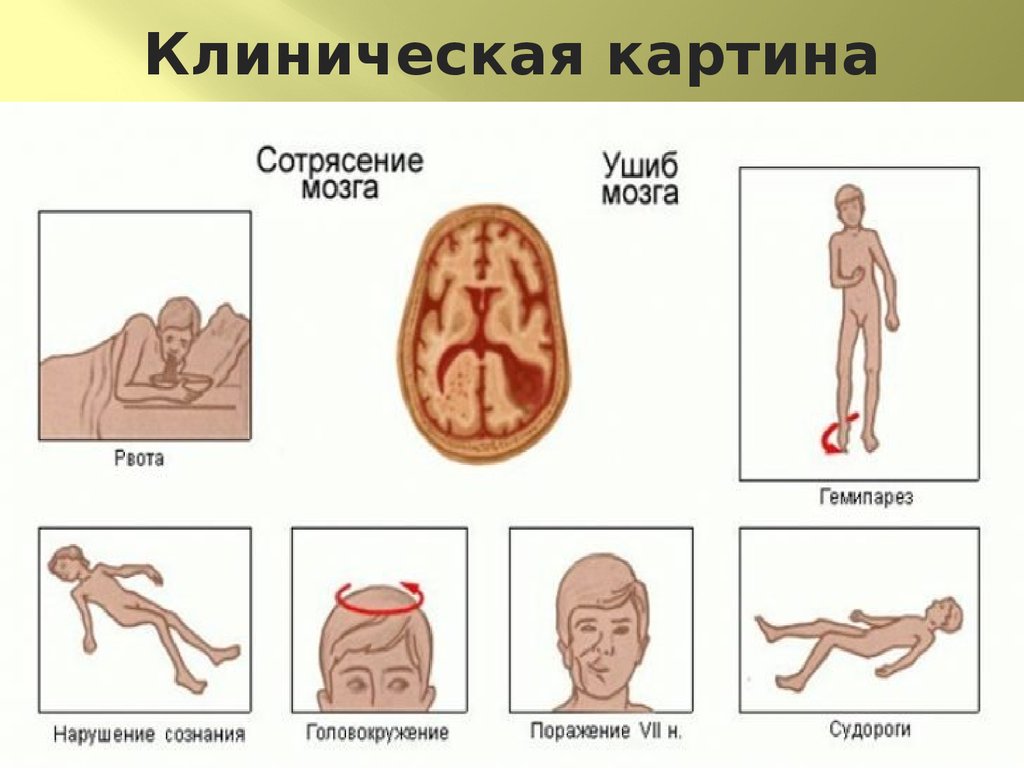 Ушиб клиническая картина