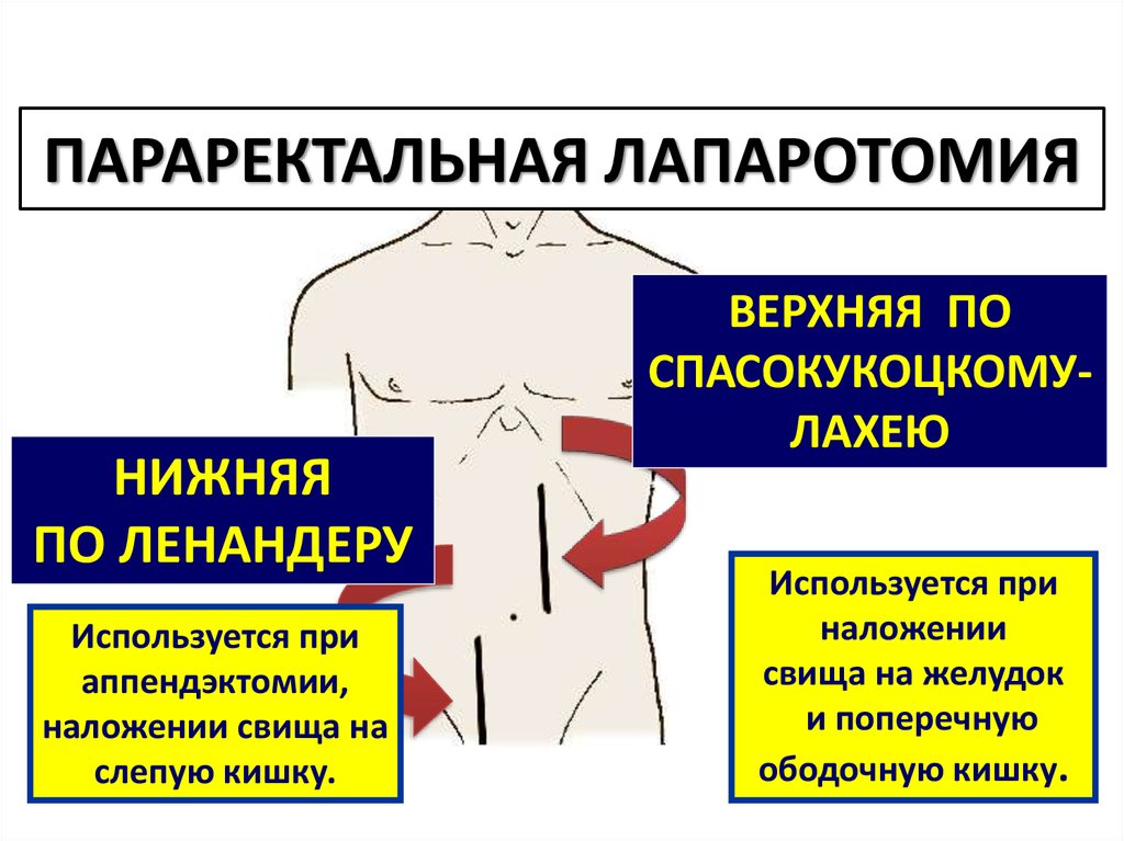 Операция лахея схема