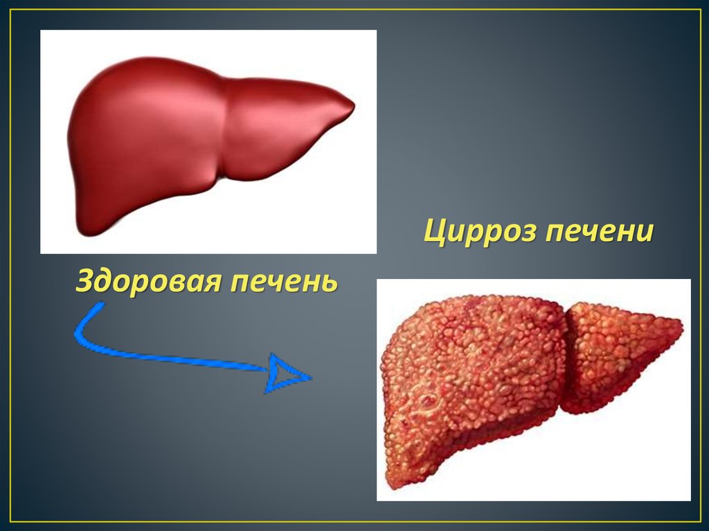 Симптомы гепатита б