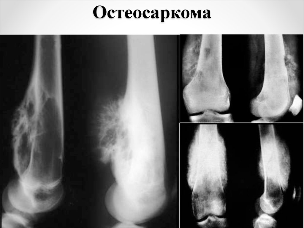 Рак кости ноги. Остеосаркома бедренной кости рентген. Остеосаркома коленного сустава рентген. Параоссальная остеогенная саркома.