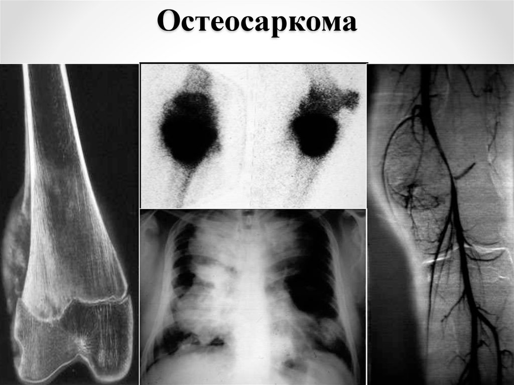 Остеосаркома. Остеобластическая остеосаркома. Остеосаркома (остеогенная саркома). Телеангиэктатическая остеосаркома.