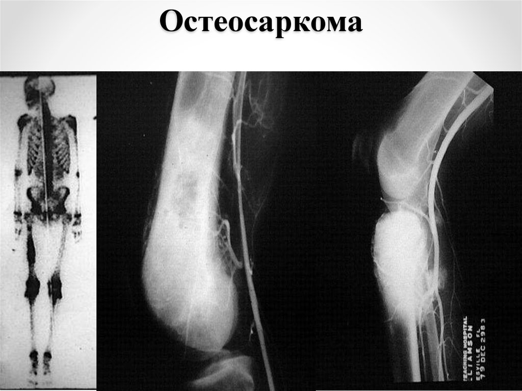 Саркома кости ноги. Остеосаркома (остеогенная саркома). Остеосаркома периостит. Телеангиэктатическая остеосаркома. Интрамедуллярная остеосаркома.