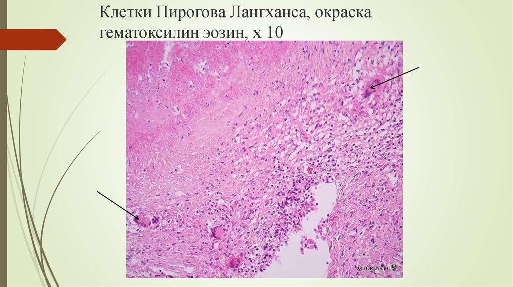 Трубная беременность микропрепарат. Солитарная Гумма печени микропрепарат.