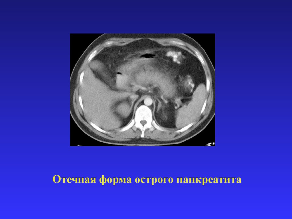 Отечный панкреатит. Острый панкреатит кт отечная форма. Отечная форма панкреатита кт. Отечно инфильтративная форма панкреатита кт.