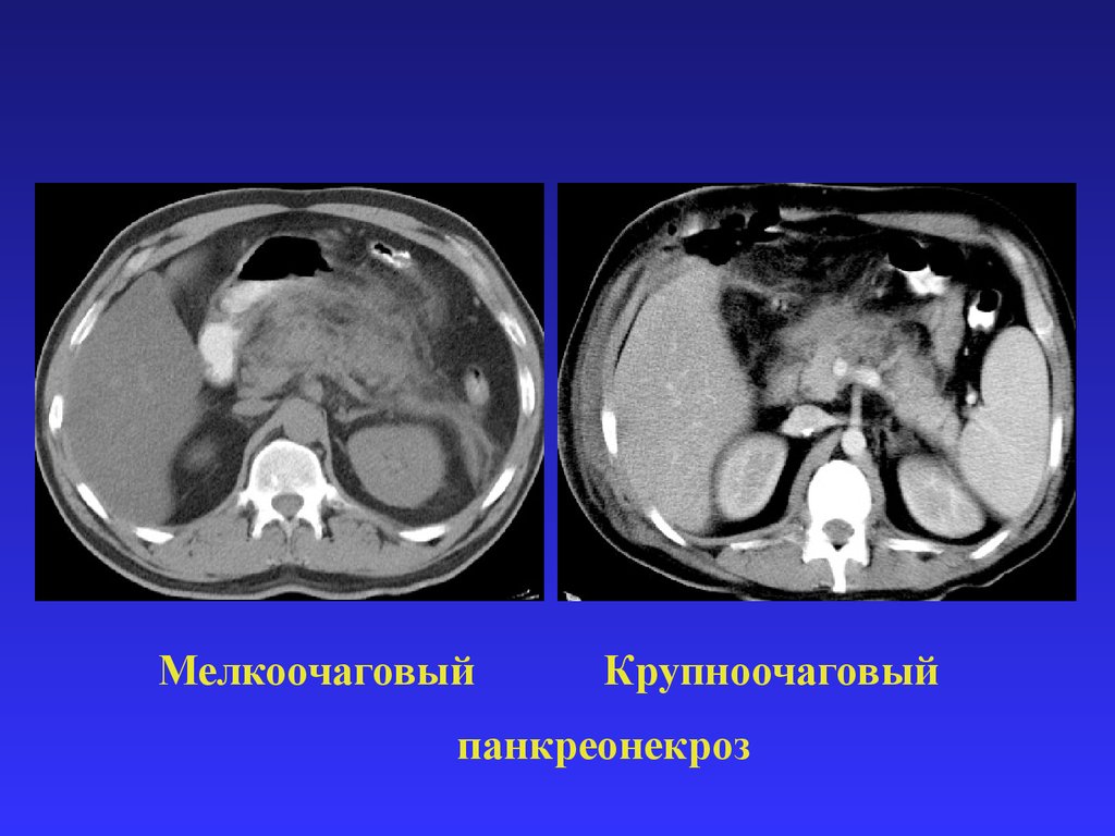 Кт картина острого панкреатита