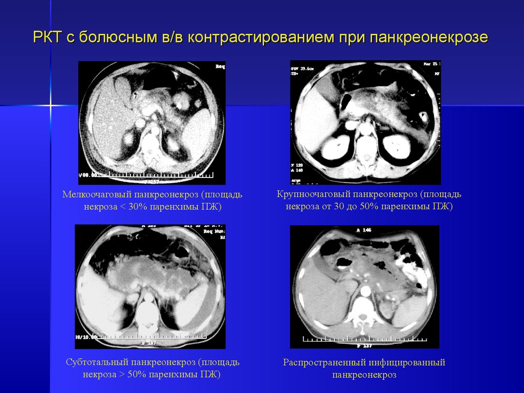 Компьютерная томография в диагностике острого панкреатита - презентация .