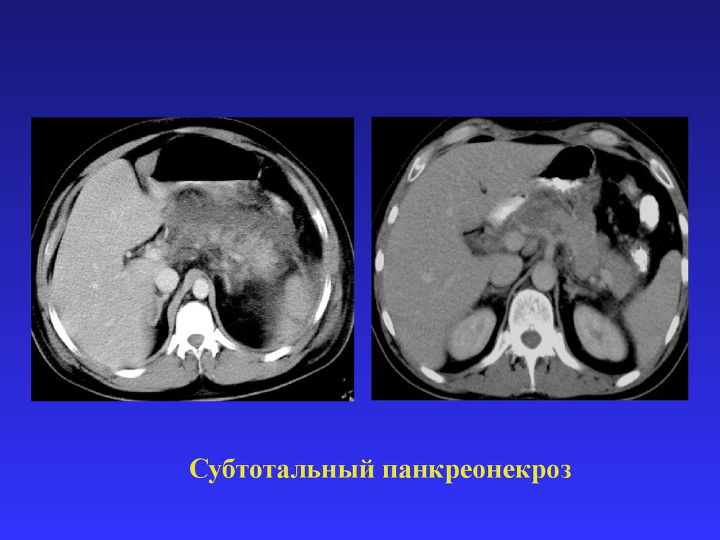 Кт картина панкреатита