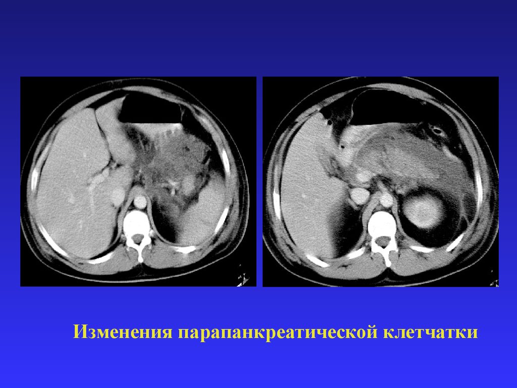 Компьютерная томография в диагностике острого панкреатита - презентация .