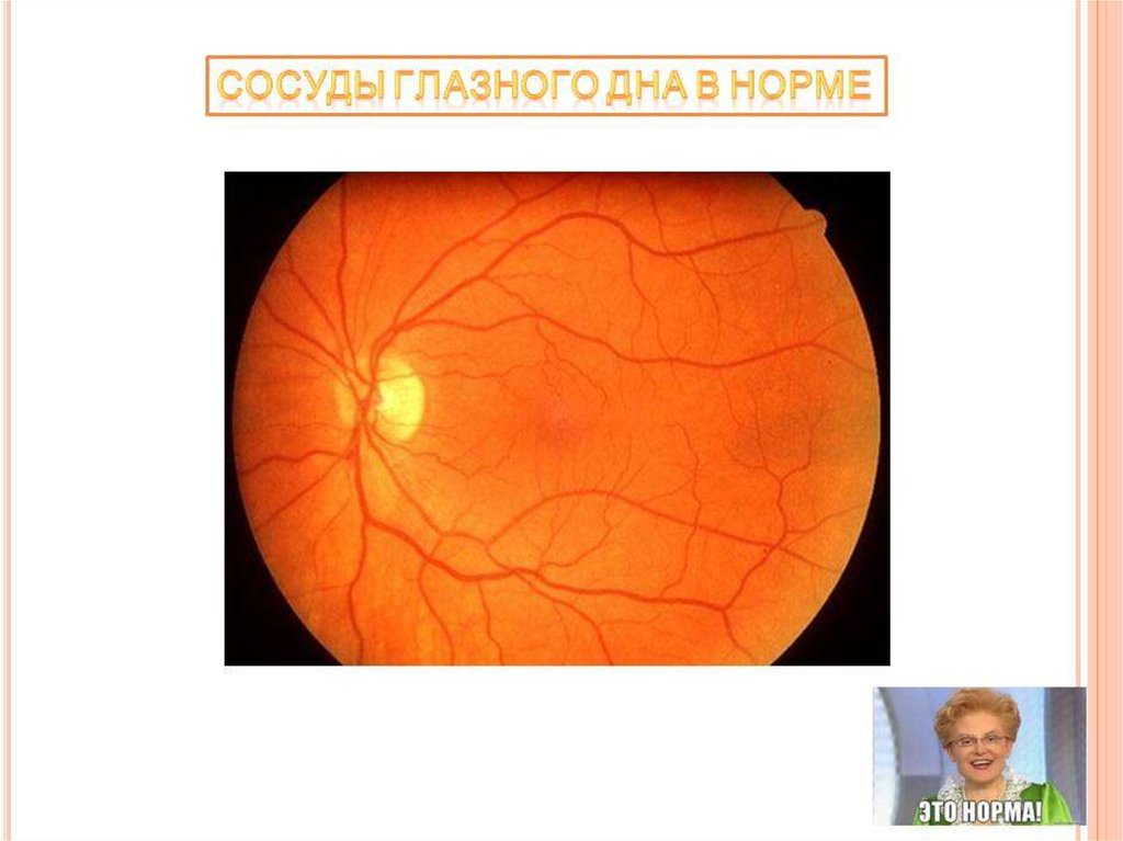 Норма глазного дна. Диабетическая ретинопатия биомикроскопия. Сосуды глазного дна в норме. Глазное дно рисунок.
