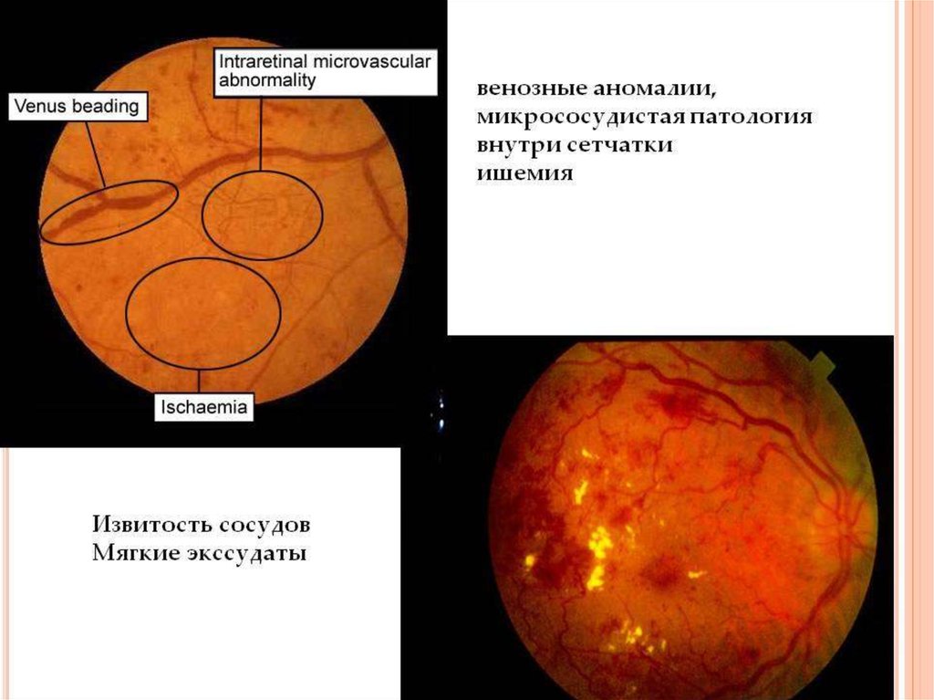 Диабетическая ретинопатия презентация офтальмология - 83 фото
