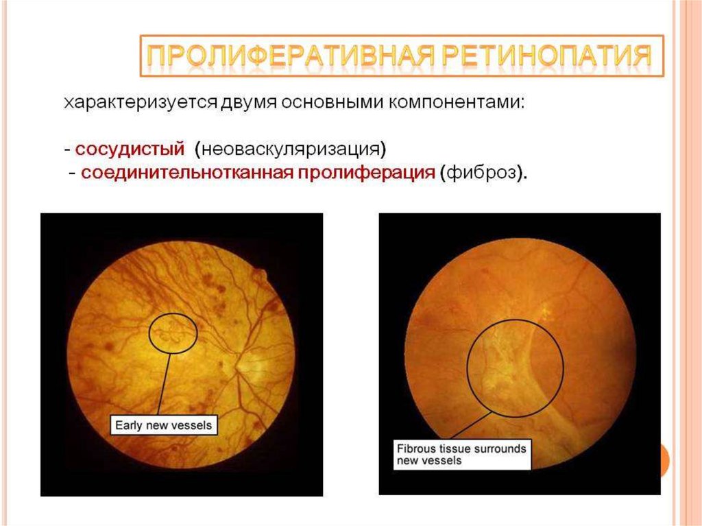 Изменение глазного дна при сахарном диабете презентация