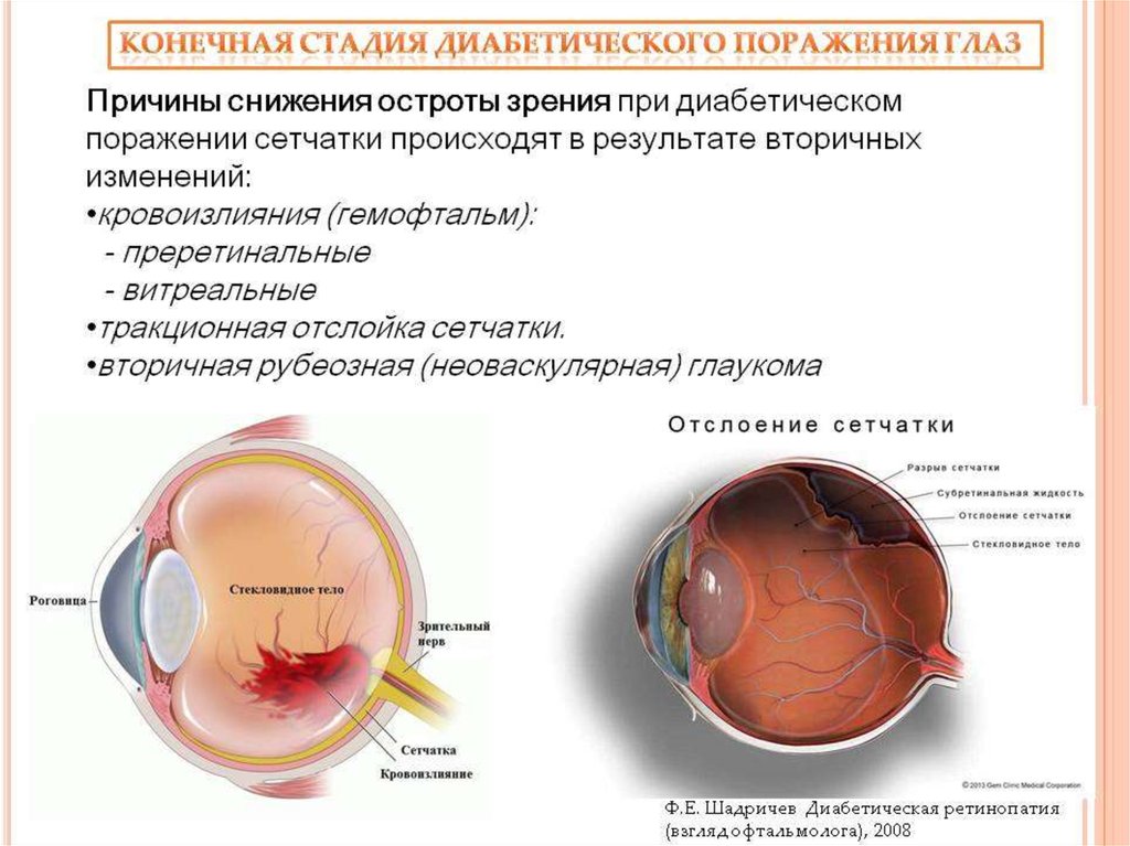Карта вызова глаукома