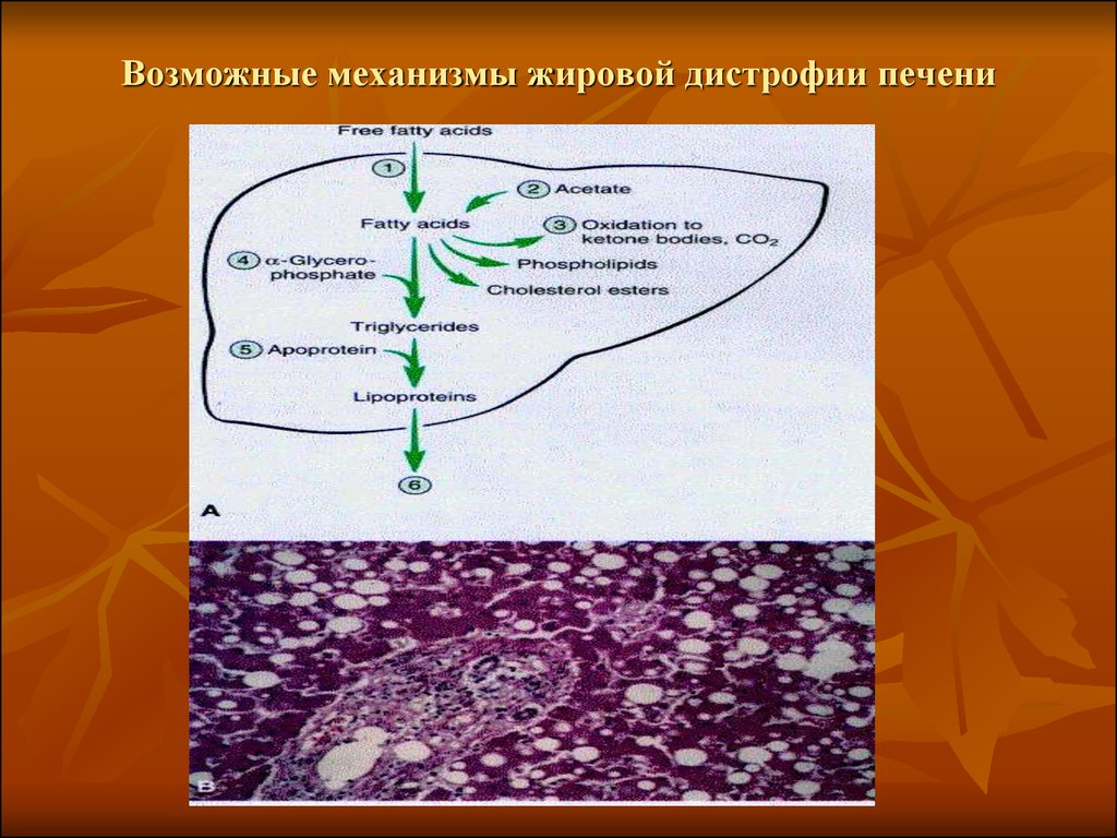 Жировая инфильтрация печени. Паренхиматозная жировая дистрофия патогенез. Механизм развития жировой дистрофии. Паренхиматозная жировая дистрофия механизм развития. Механизм жировой дистрофии печени биохимия.