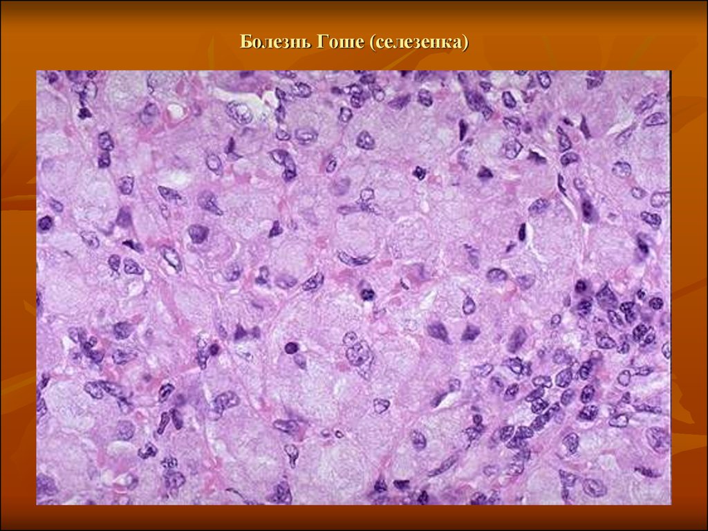 Опухоль с преобладанием паренхиматозной ткани. Болезнь Гоше микропрепарат селезенки. Гидропическая дистрофия печени. Болезнь Гоше патологическая анатомия. Болезнь Гоше селезенка макропрепарат.