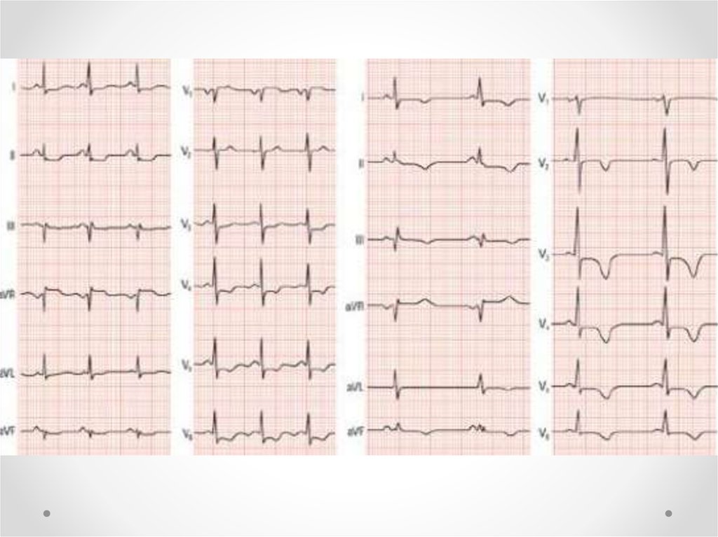 Сегмент st на экг. Элевация St 2,3, AVF. Элевация сегмента St на ЭКГ В грудных отведениях. Депрессия St v4-v6 ЭКГ. Депрессия сегмента St на ЭКГ v5 v6.