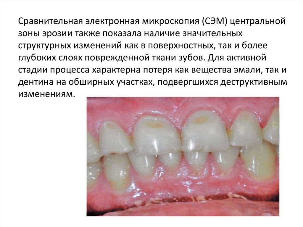 Эрозия зубов картинки