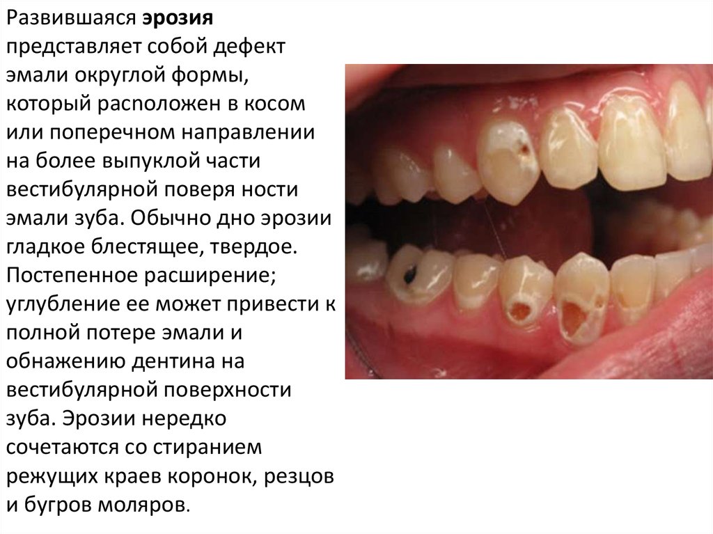 Эрозия зубов картинки