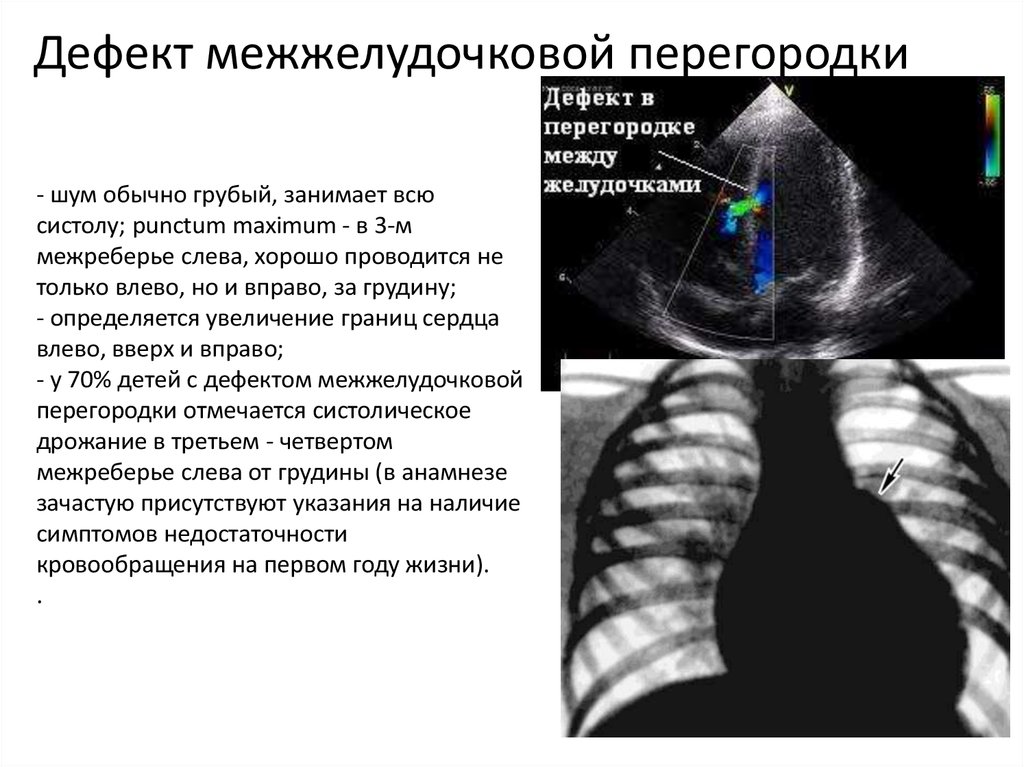 Дефект межжелудочковой. Субтрикуспидальный дефект межжелудочковой перегородки. Инфундибулярный дефект межжелудочковой перегородки. Дефект между межжелудочковой перегородки. Дефект межпредсердной перегородки рентген.