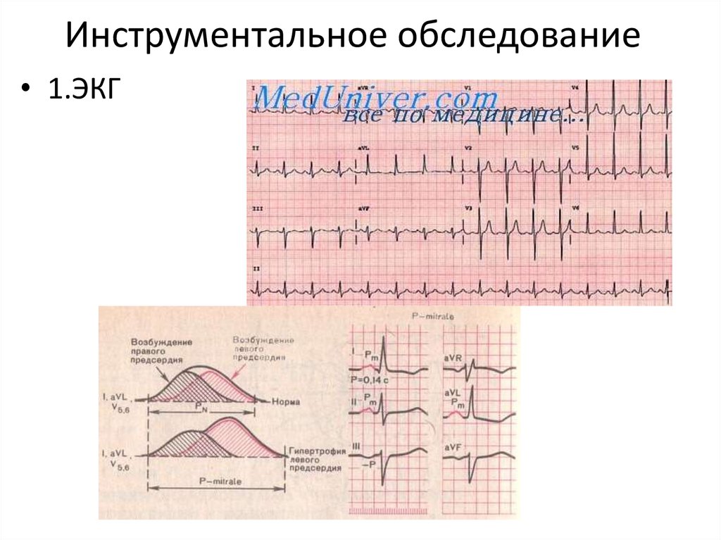 Первый экг. Порок сердца на ЭКГ. Приобретенные пороки сердца ЭКГ. Порок сердца кардиограмма. Пороки на ЭКГ.