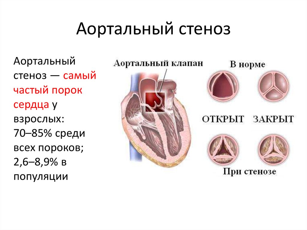 Аортальный стеноз что это такое. Стеноз аортального клапана клапан. Клапанные пороки _стеноз. Аортальный клапан сердца дефекты. Пороки сердца стенозы клапанов.