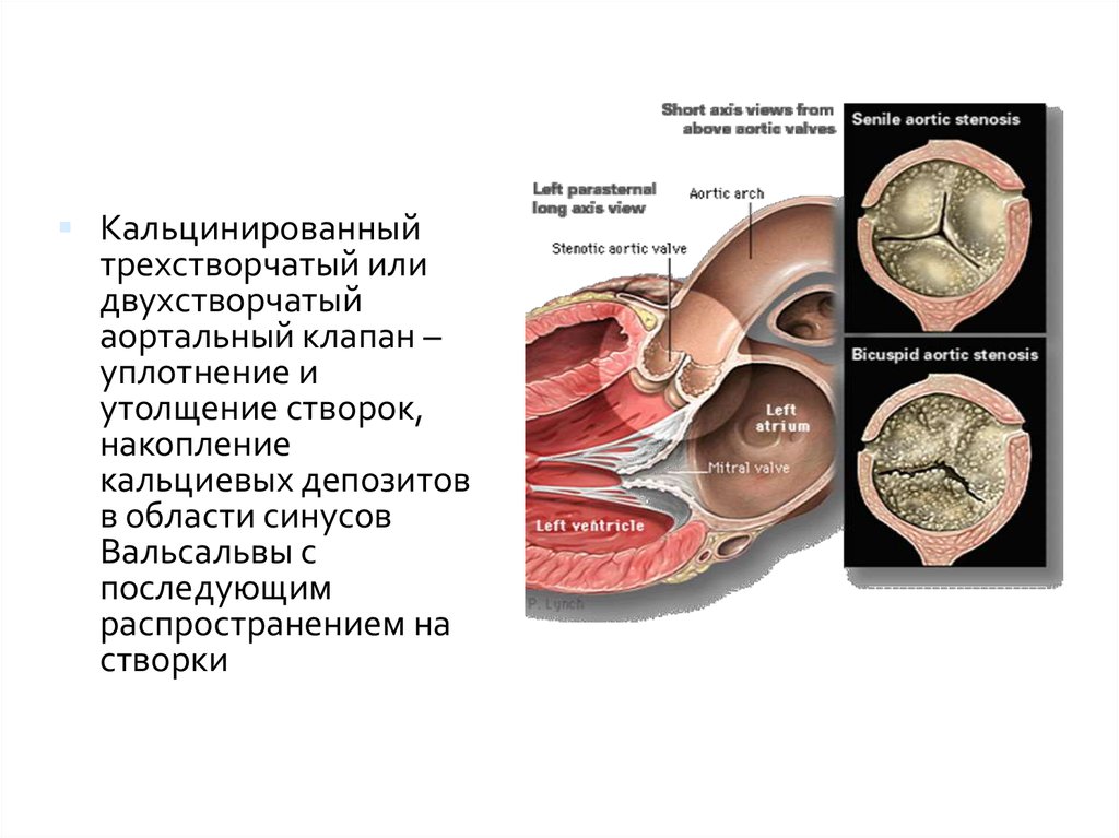 Двухстворчатый клапан человека. 2 Створчатый аортальный клапан. Двустворчатый аортальный клапан классификация. Функционально 2 створчатый аортальный клапан. ВПС 2х створчатый аортальный клапан.