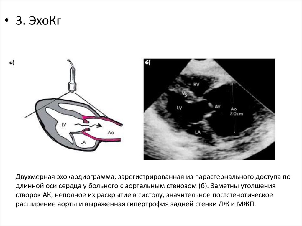 Эхокардиография сердца. Стеноз аортального клапана ЭХОКГ. Эхокардиограмма при аортальной недостаточности. Эхокардиография при стенозе аортального клапана. ЭХОКГ при недостаточности аортального клапана.