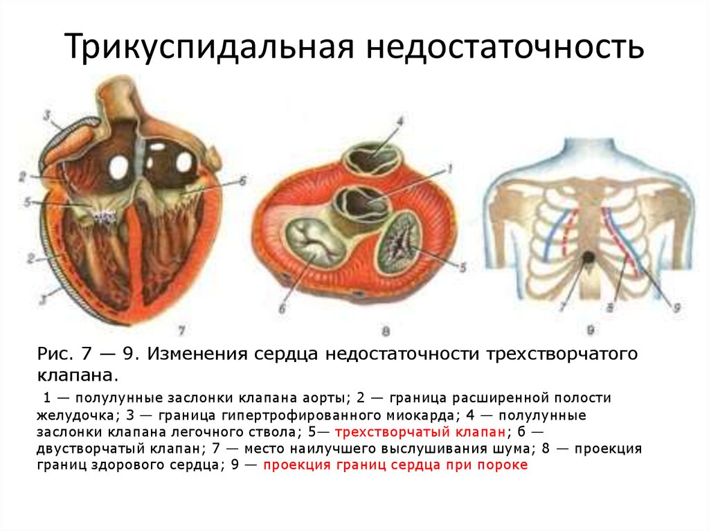 Недостаточность трехстворчатого клапана презентация