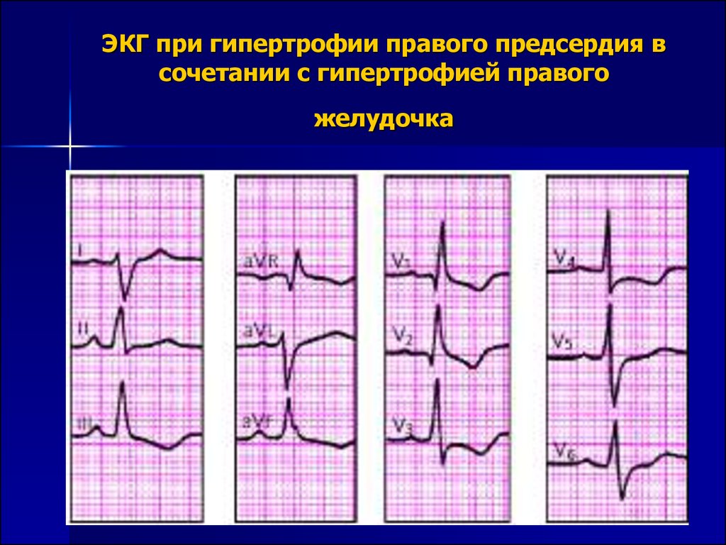 Экг гипертрофия правого. Гипертрофия пж на ЭКГ. Гипертрофия правых отделов на ЭКГ. Гипертрофия правых отделов сердца на ЭКГ. ЭКГ при гипертрофии предсердий и желудочков.